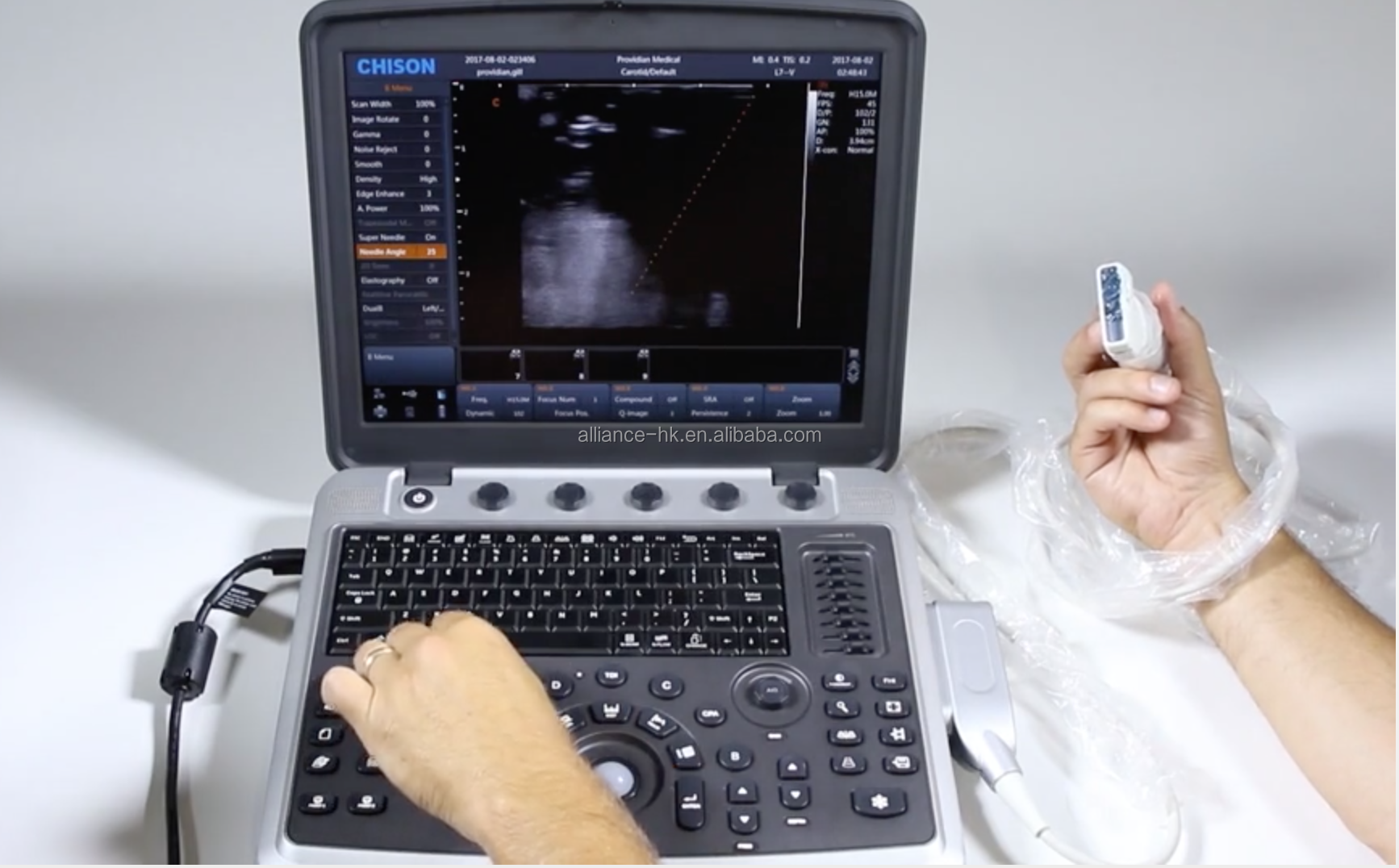 Wireless Diagnostic Ultrasound
